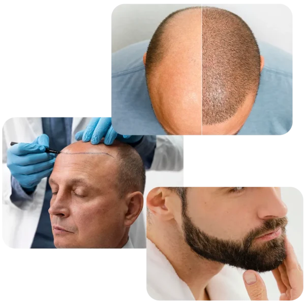 Técnica FUE — antes e depois, procedimento e barba